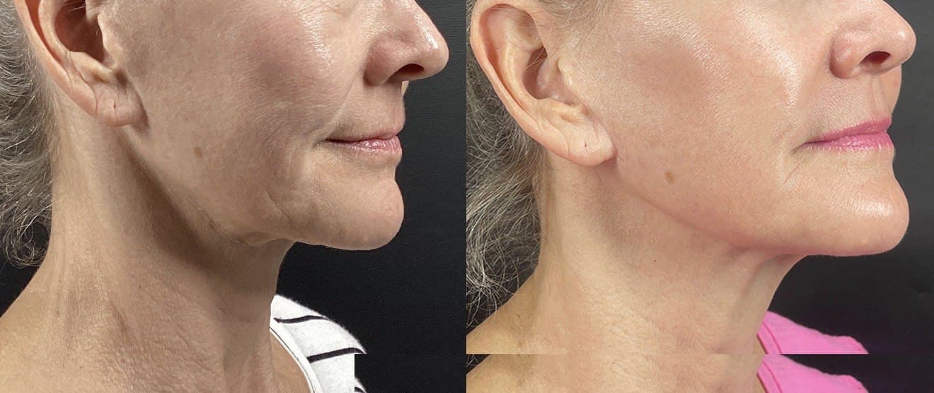Acne Scars · Morpheus8 Burst