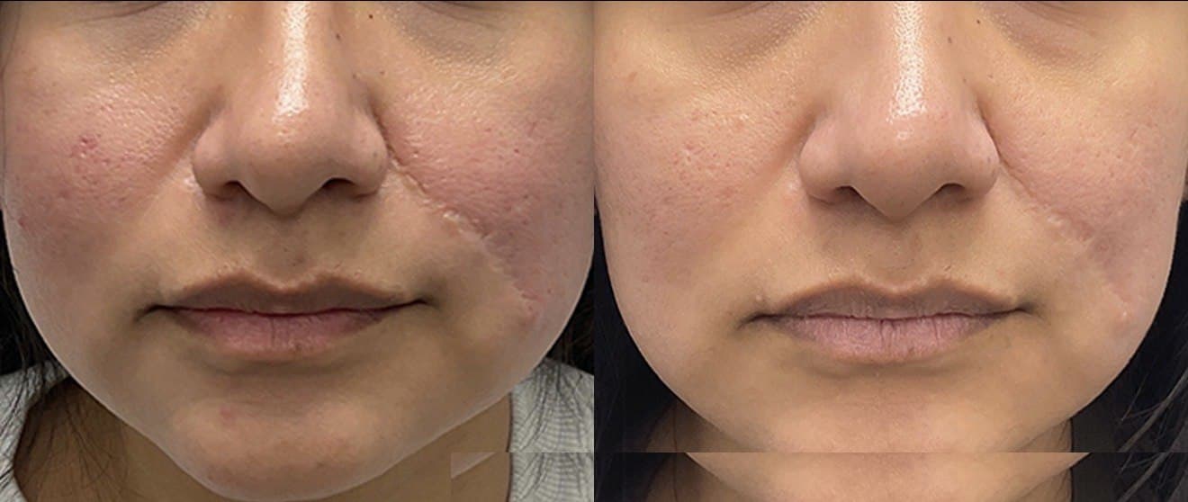 Forehead · Line Smoothing