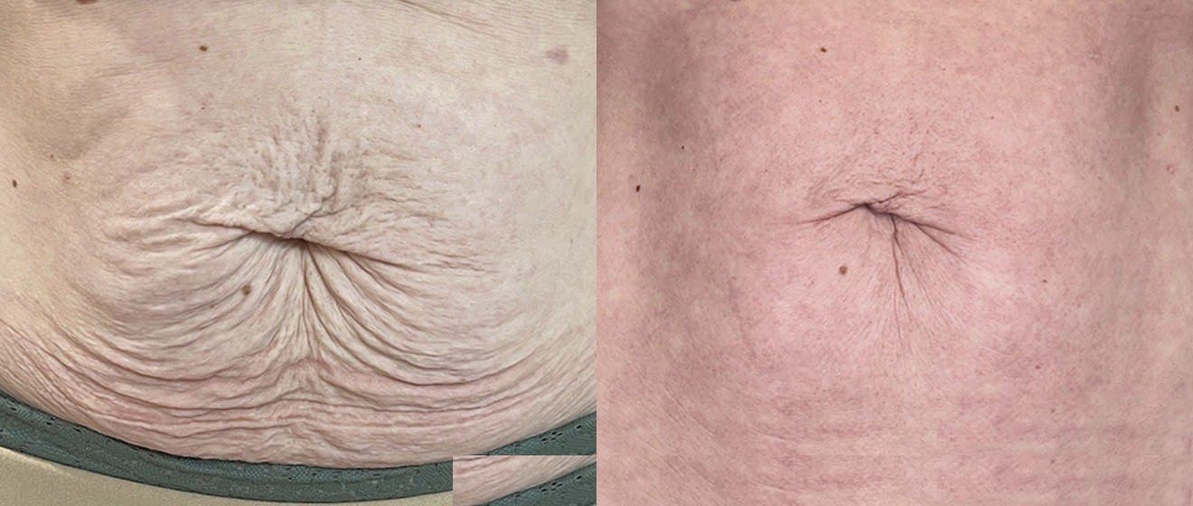 Full Face · Wrinkle Reduction