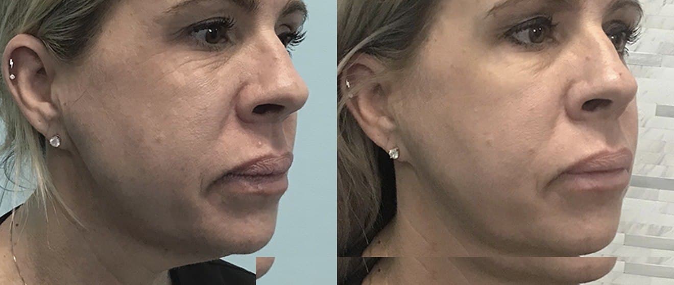 Neck & Jawline · Tightening