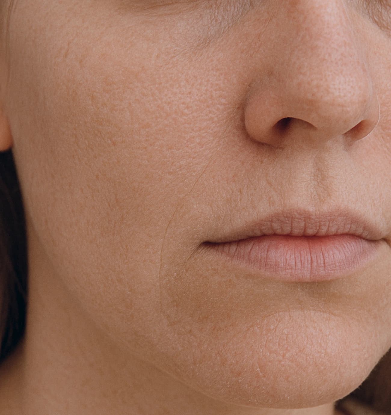 Dull-Dehydrated-Skin