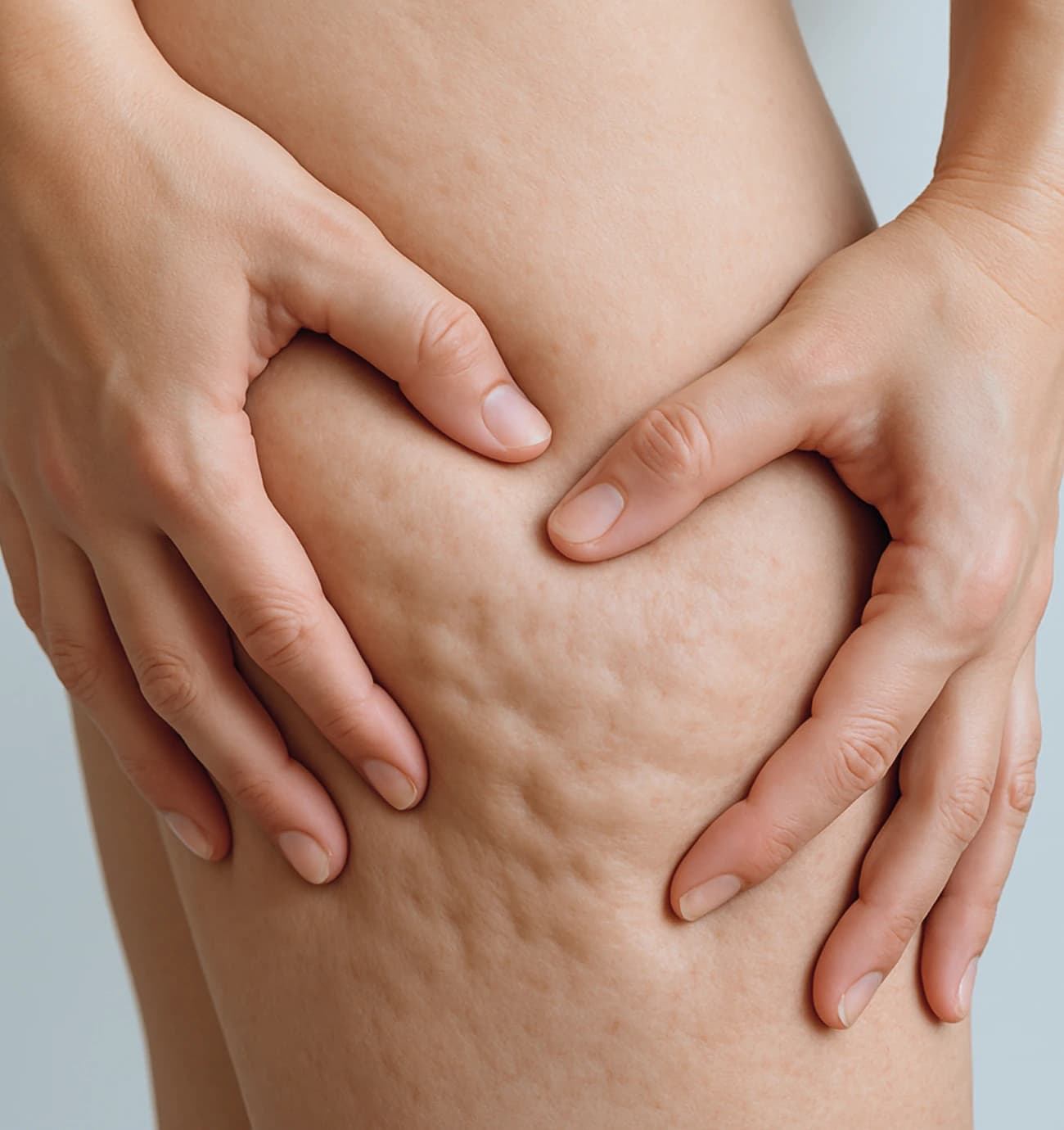 cellulite