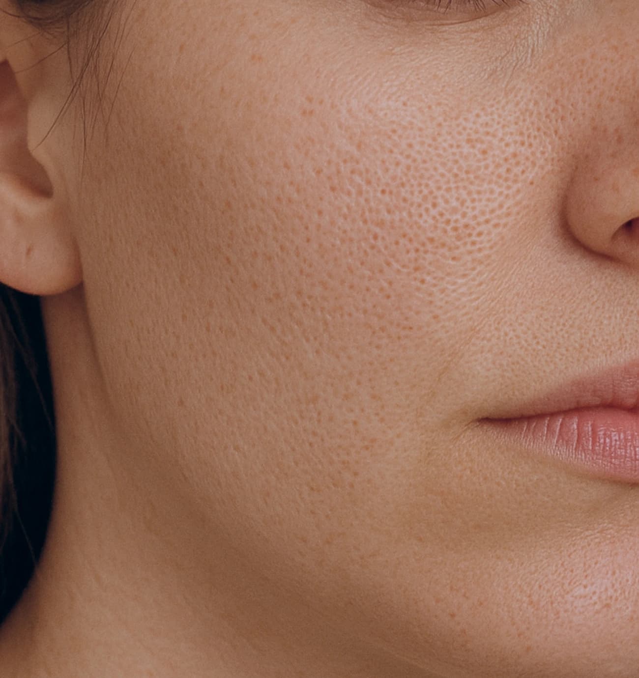 enlarged-pores
