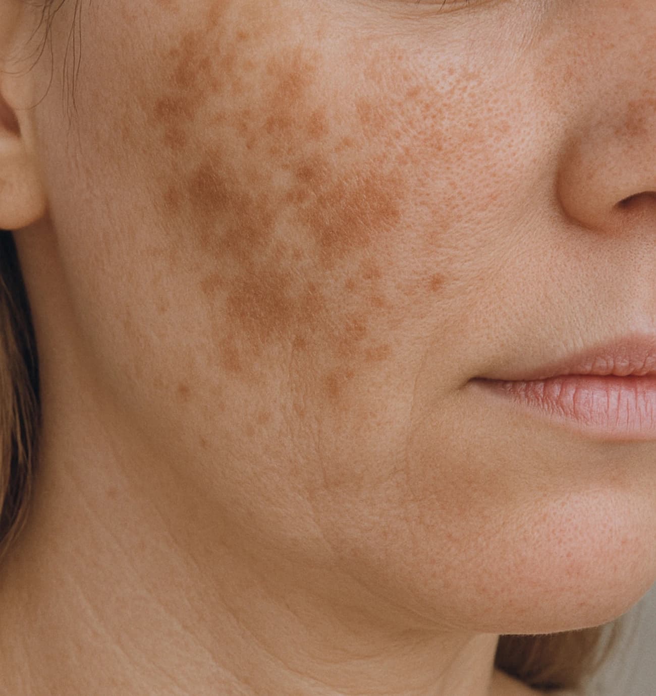 Age-Spots-and-Melasma
