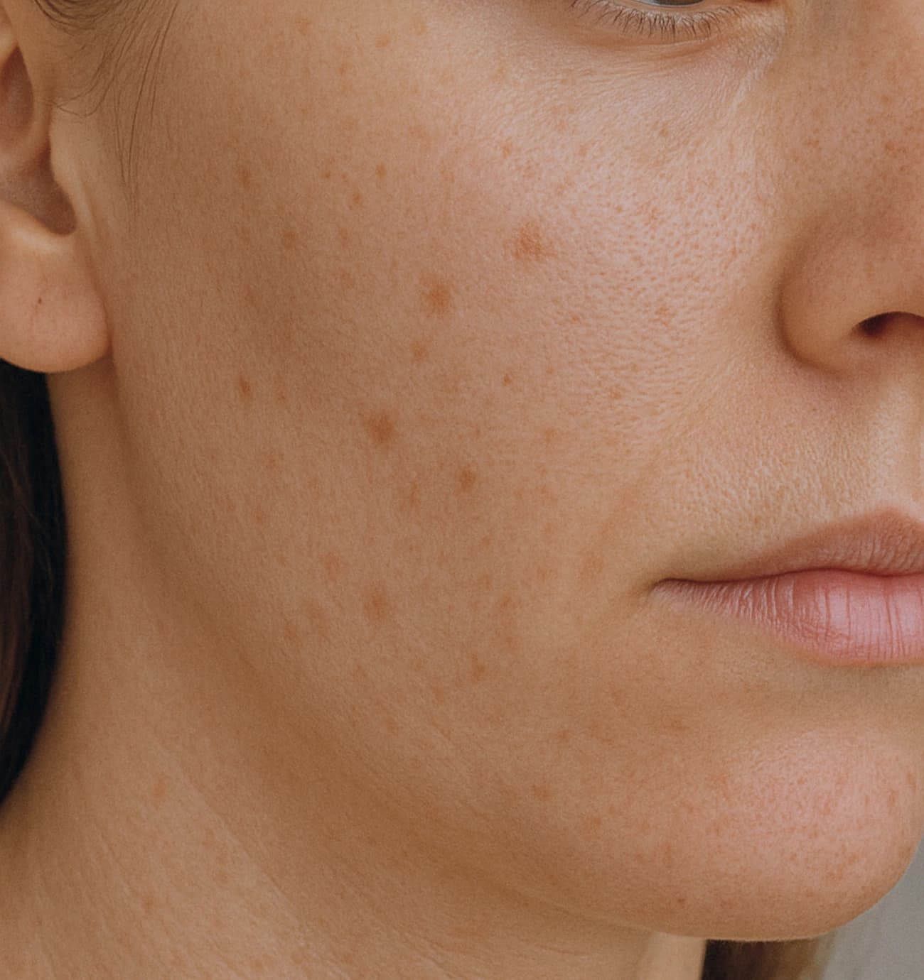 Hyperpigmentation